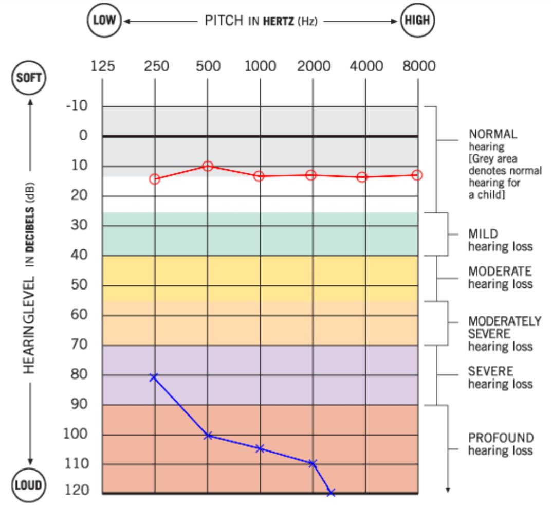 How To Read An Audiogram For Hearing Loss